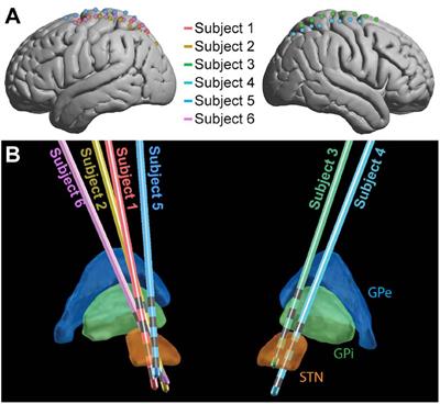 Intraoperative Characterization of Subthalamic Nucleus-to-Cortex Evoked Potentials in Parkinson’s Disease Deep Brain Stimulation